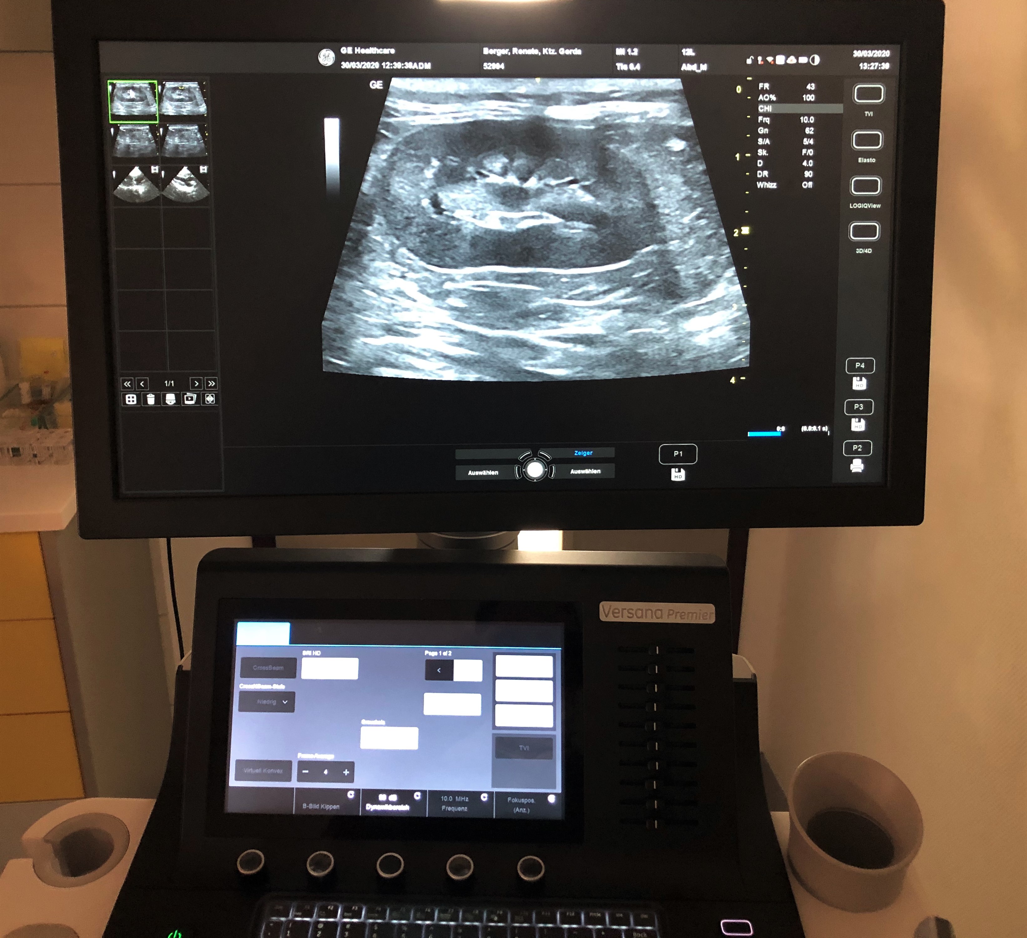 Neues Ultraschallgerät Versana Premier erlaubt beste Diagnostik im Abdomen, am Herz und an den Gelenken